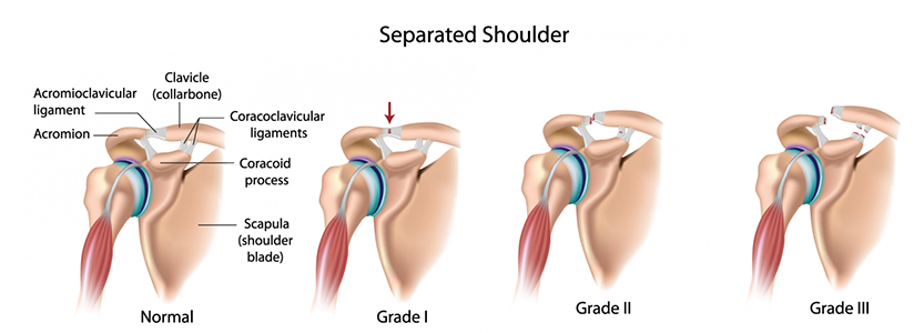 10 Tips To Get Relief From Shoulder Pain